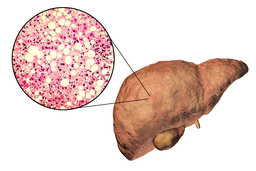 Polygenic Markers of Hepatic Steatosis and Cirrhosis