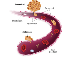 Metastases