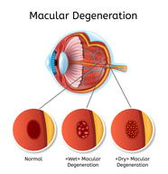Macular degeneration Macular degeneration
