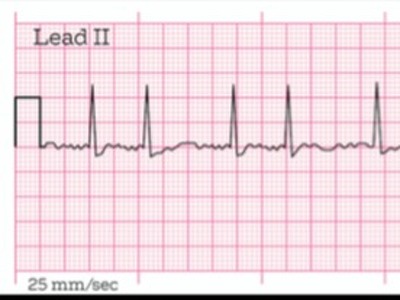 Algorithm and Device to Detect and Differentiate AF from Other Arrythmias