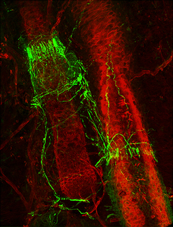 Stockade of Nerves Surround the Bulge Region of Human Scalp Hair Follicle from Male Patient with Androgenetic Alopecia