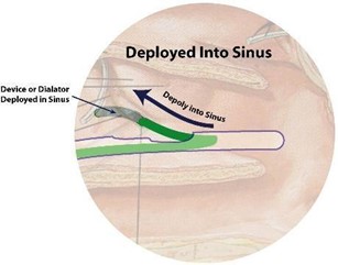 Implant is Deployed in Sinus to Open Nasal Passageways