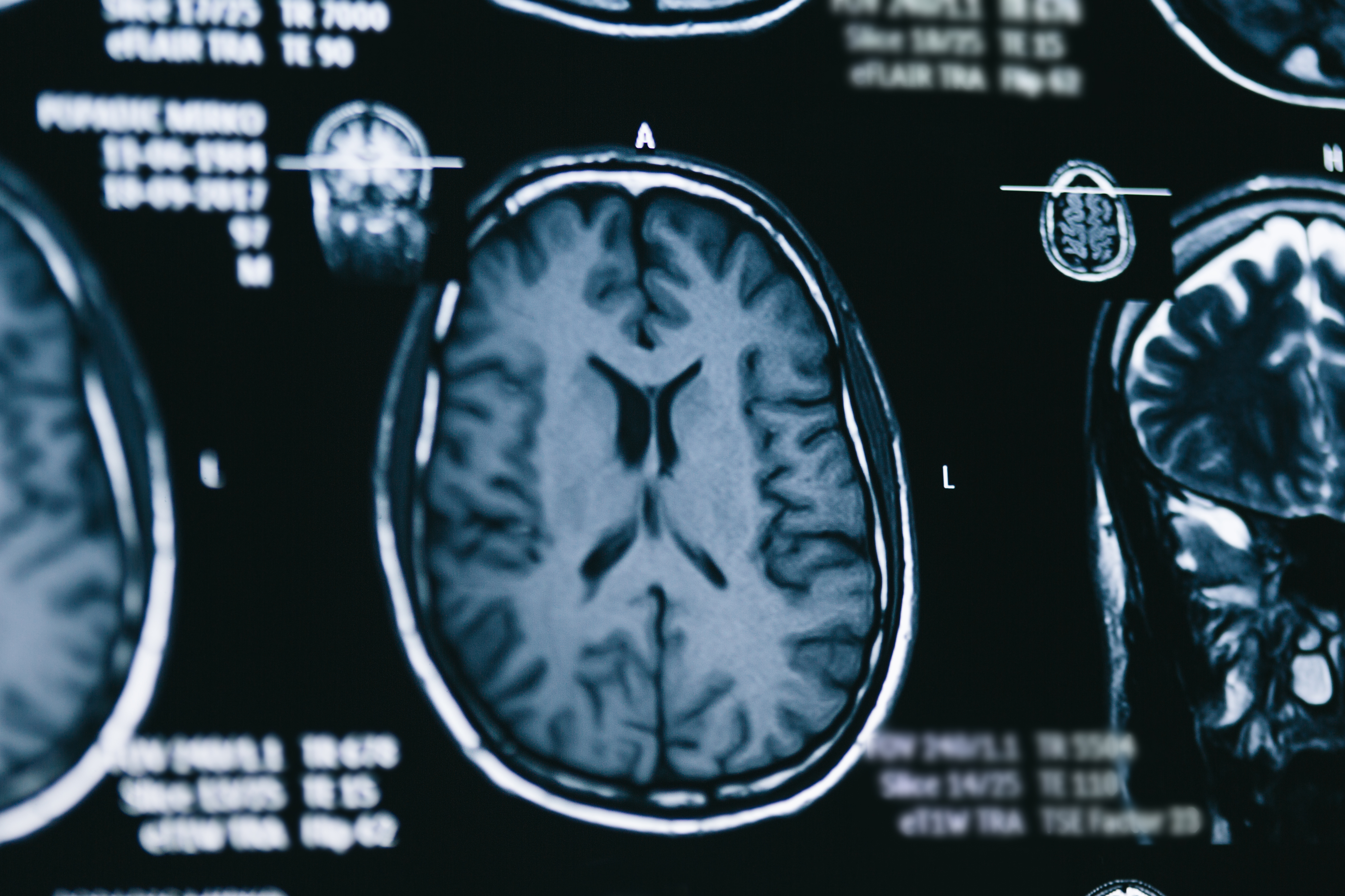 Single-Domain Antibodies (sdAbs) Against Tau and A-syn as Therapeutic and Diagnostic Tools for Neurodegenerative Diseases