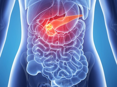 Targeting a Novel Metabolic Network for Pancreatic Ductal Adenocarcinoma (PDAC) Treatment