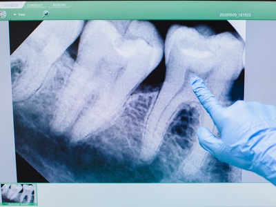 Novel, Non-Staining Filling for Minimally-Invasive Treatment of Dental Caries