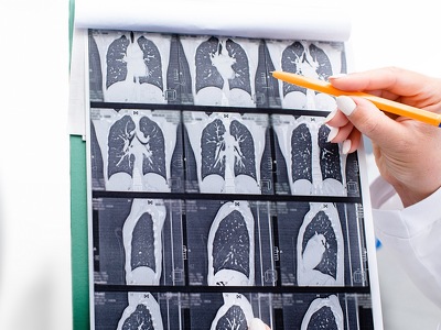 Therapeutic Targeting of KMT2D Mutant Lung Cancer Via RTK-RAS Signaling Inhibition