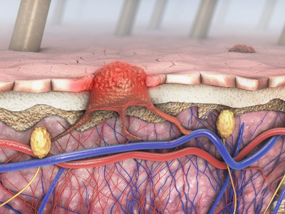 Novel Biomarker Predicting Response to Checkpoint Inhibitor Therapy in Metastatic Melanoma