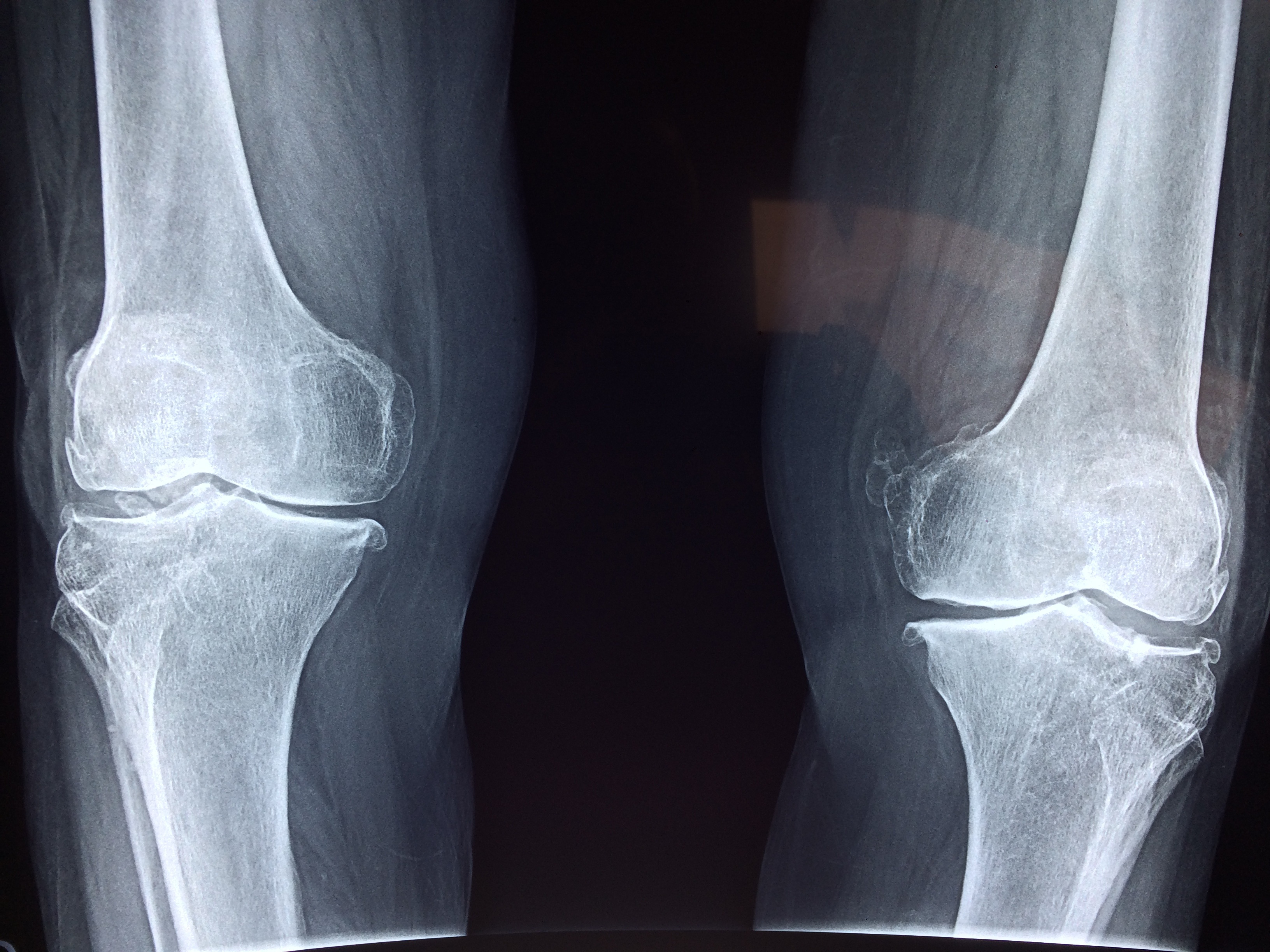 Osteoarthritis (OA) Biomarker Suitable as a Point-of-Care Diagnostic