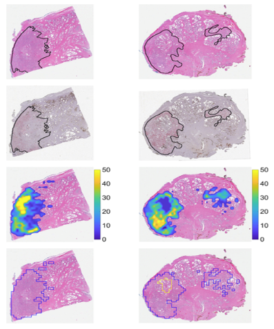 Signature maps for automatic identification of prostate cancer from histopathological specimens