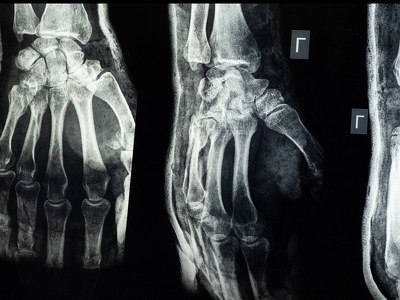 Injectable Therapeutic Hydrogel for the Treatment of Post-Traumatic Osteoarthritis