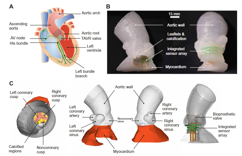 Overview of the patient-specific, 3D printed aortic root model concept and components.