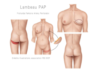 Les équipes de la Clinique Blomet réalisent la première reconstruction mammaire microchirurgicale avec la méthode pap