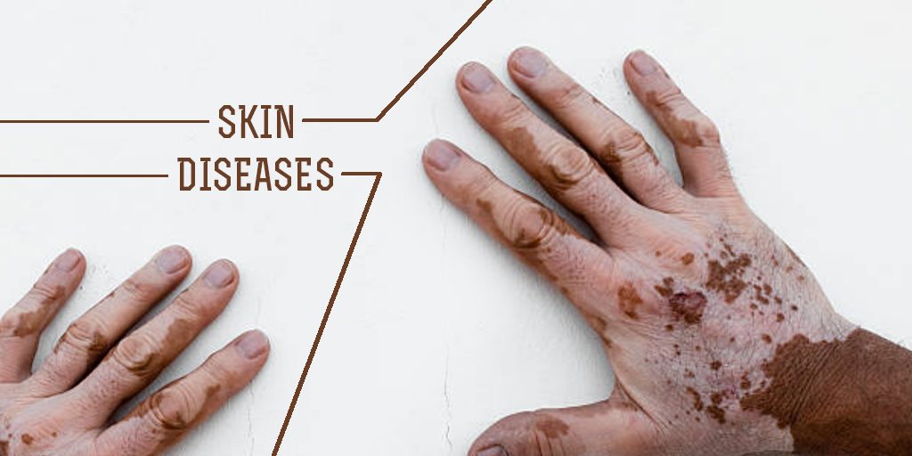 Types of Skin Disease, Buy Medicine Online, Online Pharmacy Noida, Online Medicines, Buy Medicine Online Noida, Nearby Pharmacy, Purchase Medicine Online, GoMedii