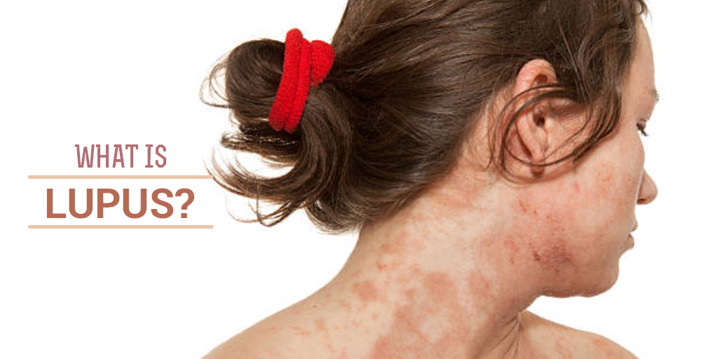 What is Lupus, Buy Medicine Online, Online Pharmacy Noida, Online Medicines, Buy Medicine Online Noida, Nearby Pharmacy, Purchase Medicine Online, GoMedii
