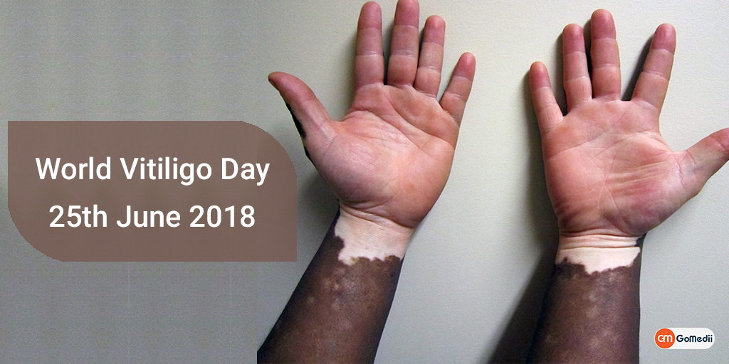 World Vitiligo Day 25th June 2018, Buy Medicine Online, Online Pharmacy Noida, Online Medicines, Buy Medicine Online Noida, Nearby Pharmacy, Purchase Medicine Online, GoMedii, Nearby Chemist, Medical Store Near Me, Cheap Medicine Online