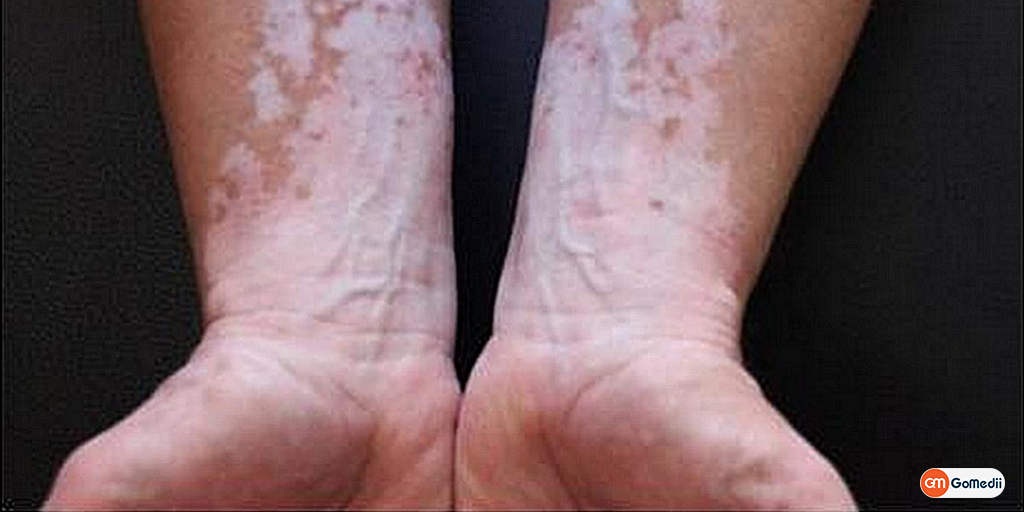 Vitiligo: Symptoms, Causes, Diagnosis & Treatment, Buy Medicine Online, Online Pharmacy Noida, Online Medicines, Buy Medicine Online Noida, Nearby Pharmacy, Purchase Medicine Online, GoMedii, Nearby Chemist, Medical Store Near Me, Cheap Medicine Online, Order Medicine Online, Online Pharmacy India, Medicine Store, Online Medical Store, Purchase Medicine Online, Medicine Online, Online Pharmacy Noida, Online Chemist Crossing Republic, Online Medicines, Buy Medicine Online India, Online Pharmacy Gaur City
