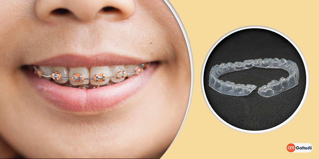 Traditional Braces Vs. Clear Aligners: Dental Care, Order Medicine Online, Online Pharmacy India, Medicine Store, Online Medical Store, Purchase Medicine Online, Medicine Online, Online Pharmacy Noida, Online Chemist Crossing Republic, Online Medicines, Buy Medicine Online India, Online Pharmacy Gaur City