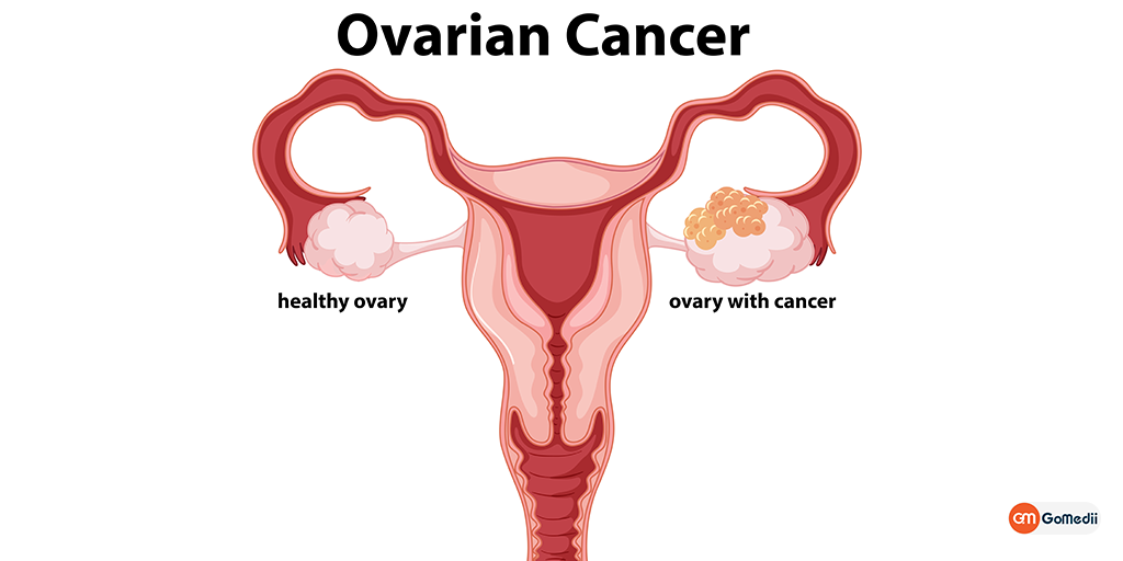 Ovarian Cancer With HIPEC Surgery, Treatment Journey of Mrs. Saud Faisal With GoMedii, Ovarian Cancer treatment in India, Causes of Ovarian Cancer, Symptoms of Ovarian Cancer, Treatments for Ovarian Cancer Ovarian Cancer: Symptoms, Causes, and Treatments, Order Medicine Online , Online Pharmacy India, Medicine Store, Online Medical Store, Purchase Medicine Online, Medicine Online, Online Pharmacy Noida, Online Chemist Crossing Republic, Online Medicines, Buy Medicine Online India, Online Pharmacy Gaur City