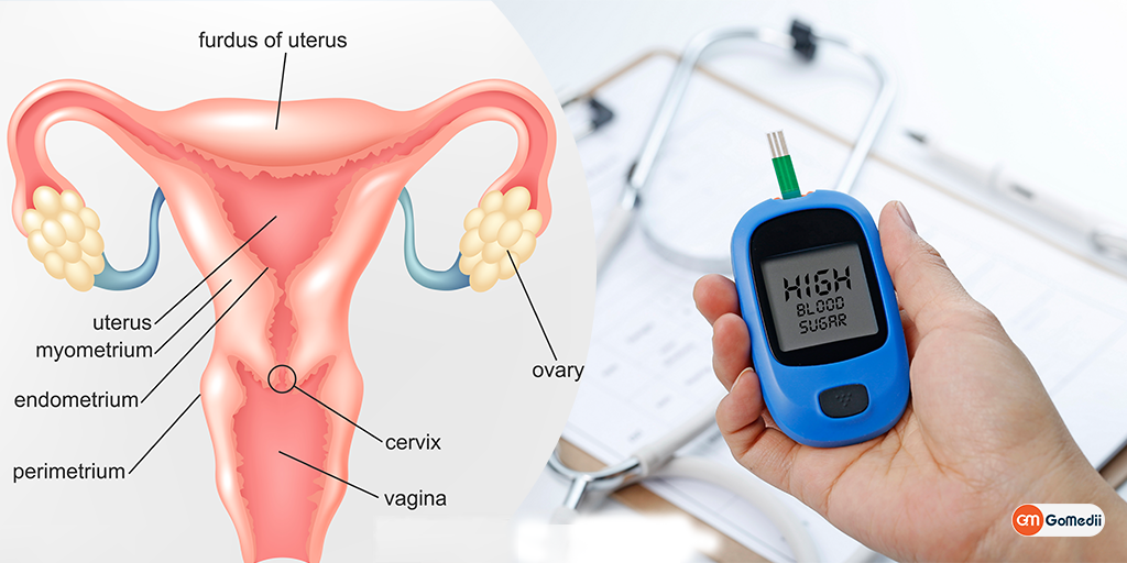Do You Know the Link Between Polycystic Ovary Syndrome (PCOS) and Diabetes, Order Medicine Online , Online Pharmacy India, Medicine Store, Online Medical Store, Purchase Medicine Online, Medicine Online, Online Pharmacy Noida, Online Chemist Crossing Republic, Online Medicines, Buy Medicine Online India, Online Pharmacy Gaur City