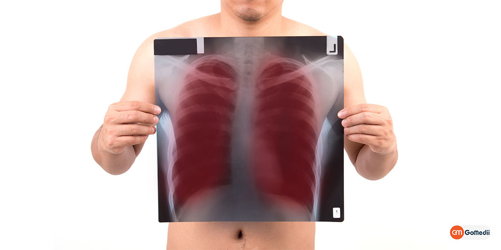 Treatment of Adenocarcinoma in India, Adenocarcinoma treatment cost in India, treat adenocarcinoma of the lung, symptoms of Adenocarcinoma, condition of Adenocarcinoma Treatment of Adenocarcinoma in India, Adenocarcinoma treatment cost in India, treat adenocarcinoma of the lung, symptoms of Adenocarcinoma, condition of Adenocarcinoma