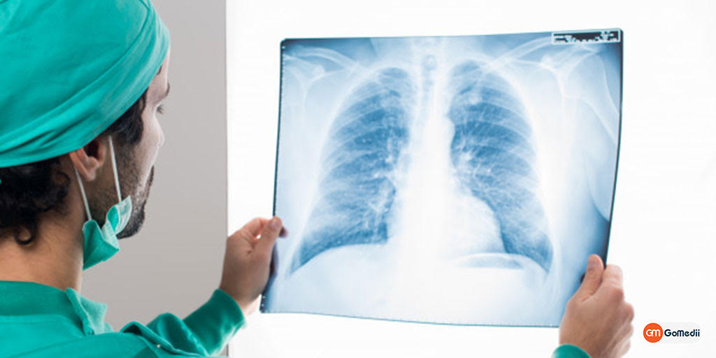 Lung Cancer: Symptoms, Causes & Treatment, Medicines, Online Medicines, Order Medicine Online, Online Pharmacy, Buy Medicine, Purchase Medicine, Medicine Home Delivery, Pharmacy Near Me, Medical Store Near me, Fast Delivery of Medicine, Discount On Medicines, Book Appointment With Doctor, Online Doctor, Doctor Consultation Online, Second Opinion With Doctor