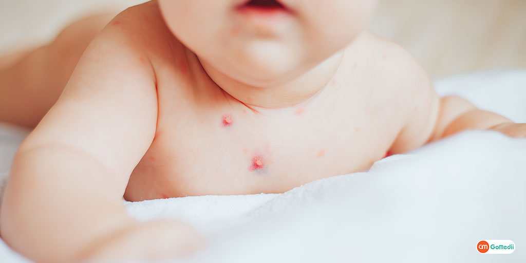 Know The Difference Between Smallpox and Chickenpox.
