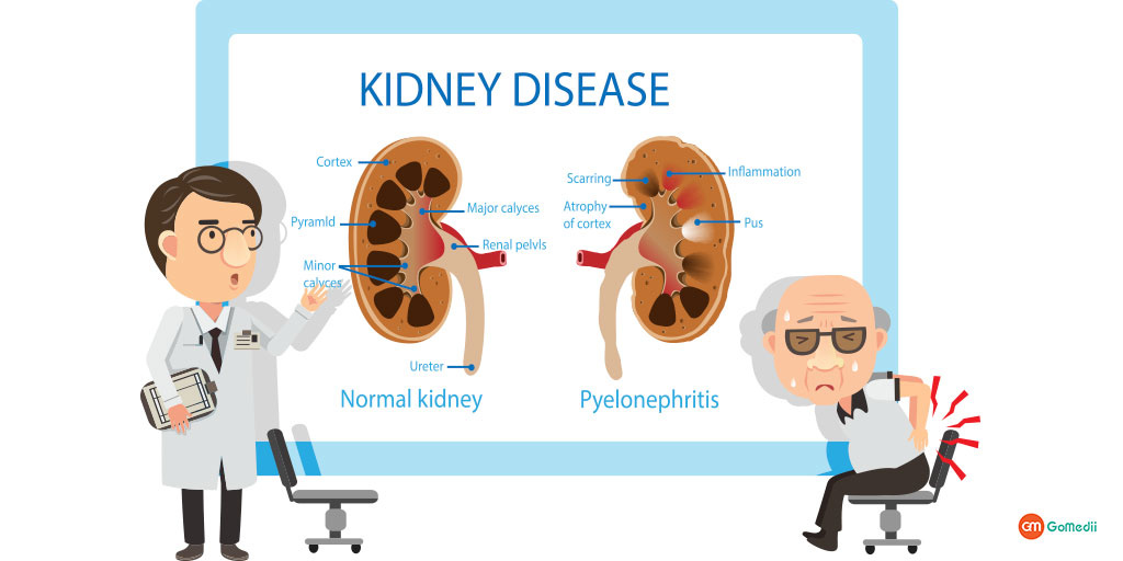 What Causes CKD Know the Causes and Prevent It.