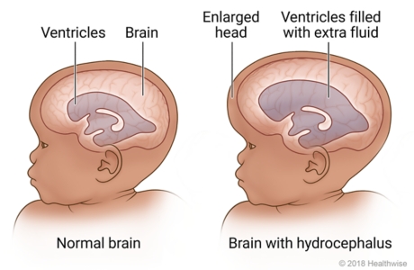 Hydrocephalus