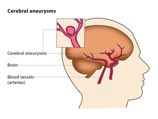 Intracranial Aneurysm Treatment In India, Intracranial Aneurysm, best cancer hospitals in India, type of brain aneurysms, Saccular Aneurysms, Fusiform Aneurysms, Symptoms of an Intracranial Aneurysm, Diagnosing an Intracranial Aneurysm for Treatment, Intracranial Aneurysm Treatment, Endovascular Embolization, Microvascular Clipping, Flow Diversion Surgery, Intracranial Aneurysm Treatment Cost in India, Benefits of Pursuing Intracranial Aneurysm Treatment in India