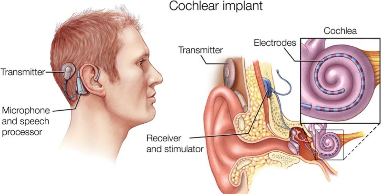 Cochlear Implant In MGM Hospital Chennai, Cochlear Implant in chennai, Mahira's Case at MGM Hospital, Mahira's parents contact GoMedii, procedure for the implant,  Cochlear Implant Hospital In Chennai