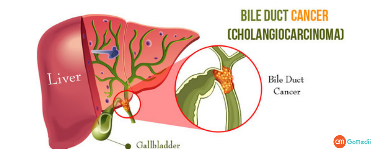 Get Aware About The Rare Bile Duct Cancer!- GoMedii