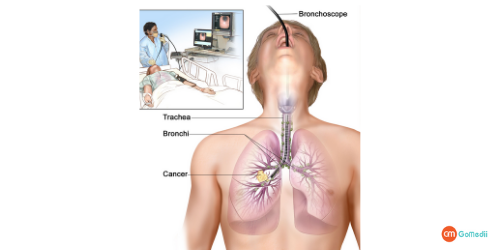 Bronchoscopy cost in kolkata