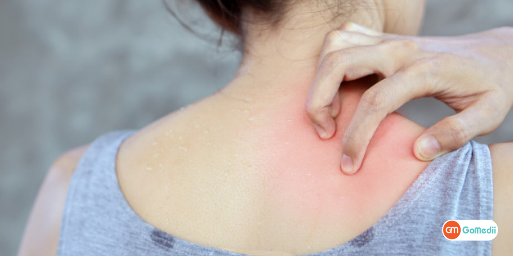 How To Manage Your Hives? Try These Easy Methods to Get Rid!-GoMedii