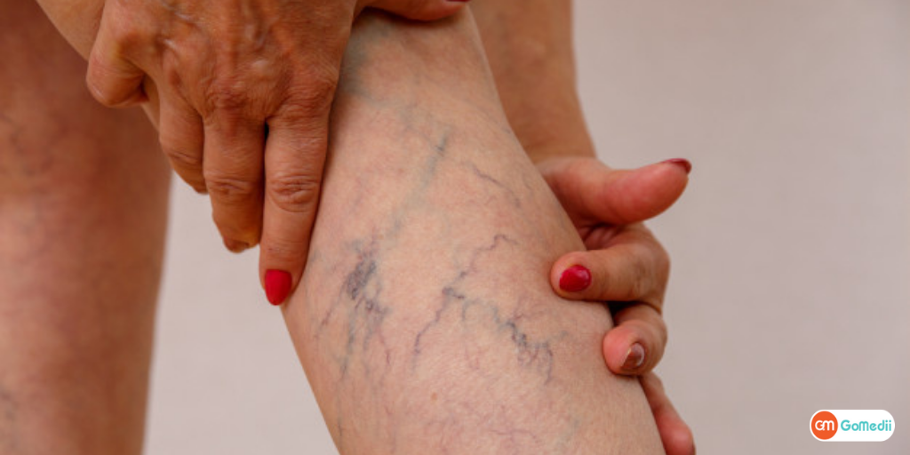Know the Cause, Symptoms and Spider Vein Removal Treatment-GoMedii