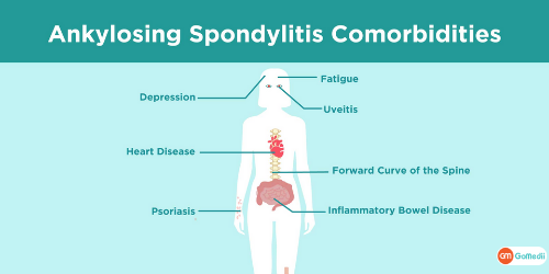 Ankylosing Spondylitis Cardiac, Ankylosing Spondylitis Cardiac Issues, Association of Ankylosing Spondylitis Cardiac Issues, complication of ankylosing spondylitis