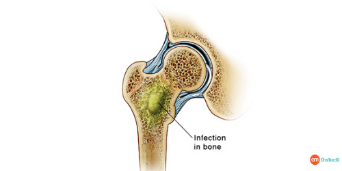 Osteomyelitis, Waist infection, Broken Leg, diagnose Osteomyelitis, Technetium-99 pyrophosphate, Magnetic Resonance Imaging, Radiographs (X-Rays)