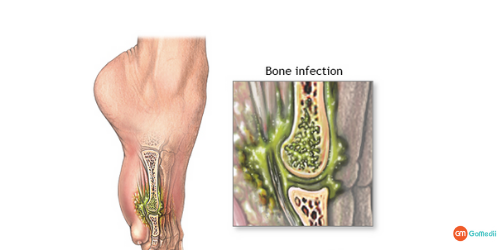 Bone Infection 