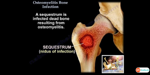 Osteomyelitis, Waist infection, Broken Leg, diagnose Osteomyelitis, Technetium-99 pyrophosphate, Magnetic Resonance Imaging, Radiographs (X-Rays)