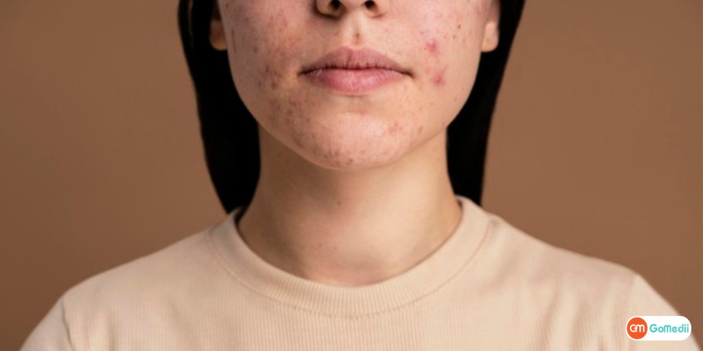 Differentiating Between Pimples and Acne: Effective Healing Techniques Unveiled
