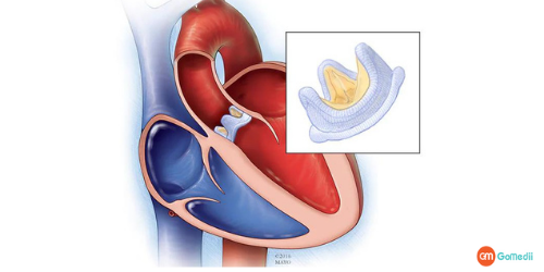 Keyhole Heart Surgery, Cost of Keyhole Heart Surgery, Mechanical valves, Biological valve, Keyhole Heart Surgery Mitral Valve
