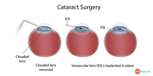 Cataract Surgery Cost, Cataract Surgery, Symptoms Of Cataract, Causes Of Cataract, Types of Cataracts, Treatment For Cataracts, Types Of Cataract Surgery