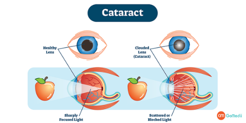 Cataract Surgery Cost In Delhi, Cataract Surgery In Delhi, Symptoms Of Cataract, Causes Of Cataracts, Types of Cataracts, Treatment For Cataracts, Phacoemulsification, Extracapsular cataract surgery, Intracapsular cataract surgery
