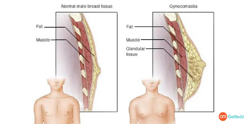 Gynecomastia Surgery, Liposuction, Mastectomy, Gynecomastia Surgery Cost, Gynecomastia Surgery Cost In Delhi, gynecomastia hospital