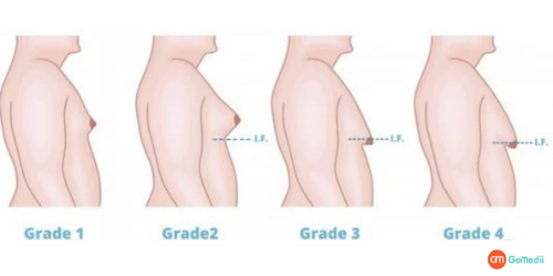 Gynecomastia Surgery, Liposuction, Mastectomy, Gynecomastia Surgery Cost, Gynecomastia Surgery Cost In Delhi, gynecomastia hospital