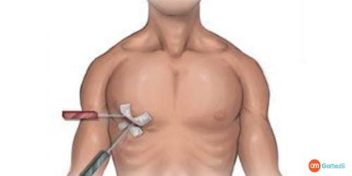 Keyhole Heart Surgery, Cost of Keyhole Heart Surgery, Mechanical valves, Biological valve, Keyhole Heart Surgery Mitral Valve