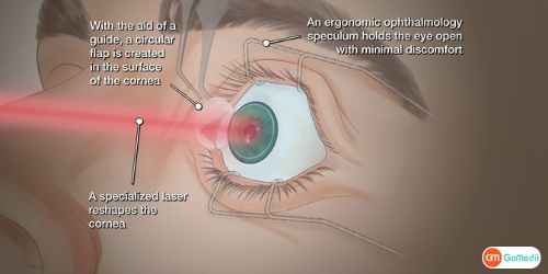Laser Eye Surgery Cost In Delhi, Laser Eye Surgery In Delhi, Laser Operation For Eyes Cost In India, Laser Eye Operation In Mumbai, Lens Replacement Surgery In India Laser Eye Surgery Cost In Delhi, Laser Eye Surgery In Delhi, Laser Operation For Eyes Cost In India, Laser Eye Operation In Mumbai, Lens Replacement Surgery In India