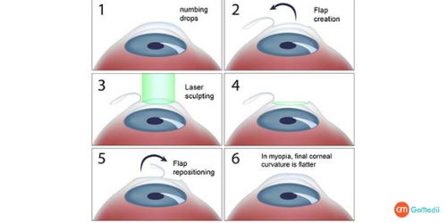 LASIK eye surgery, Laser Eye Surgery A Permanent Solution, LASIK Eye Surgery Procedure, Cost Of the LASIK Surgery LASIK eye surgery, Laser Eye Surgery A Permanent Solution, LASIK Eye Surgery Procedure, Cost Of the LASIK Surgery