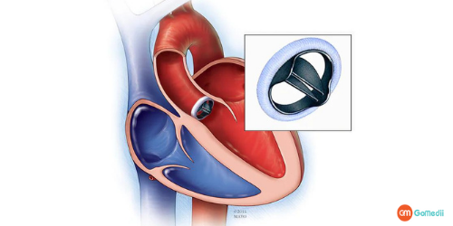 Heart Blockage Surgery In India, Blockage Surgery Cost In India, Bypass Surgery Cost In India, Heart Surgery cost in India, Open Heart Surgery Cost In Apollo, Best Cardiologist in India, Hospitals For Heart Blockage Surgery In India, Bypass Surgery Cost In Kerala