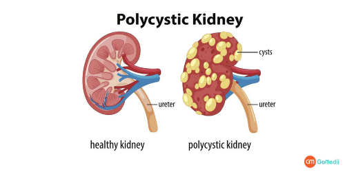 Kidney Cyst Removal Surgery In Noida, Risk Of A Kidney Cyst, Cure A Kidney Cyst, Causes Of Kidney Cortical Cysts, Polycystic Kidney Disease Treatment In Noida, Polycystic Kidney Disease