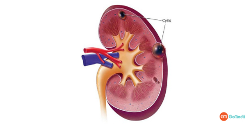 Kidney Cyst Removal Surgery In Noida, Risk Of A Kidney Cyst, Cure A Kidney Cyst, Causes Of Kidney Cortical Cysts, Polycystic Kidney Disease Treatment In Noida, Polycystic Kidney Disease